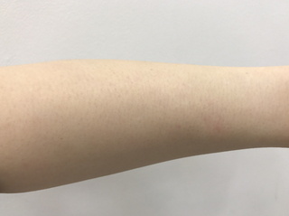 001_使用前　腕.jpg
